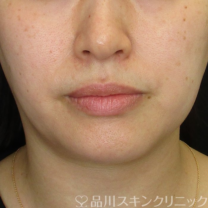 症例NO.74628のBEFORE写真