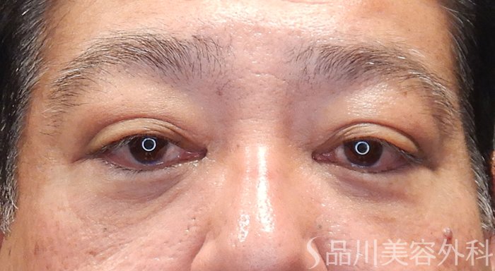 症例NO.69898のAFTER写真