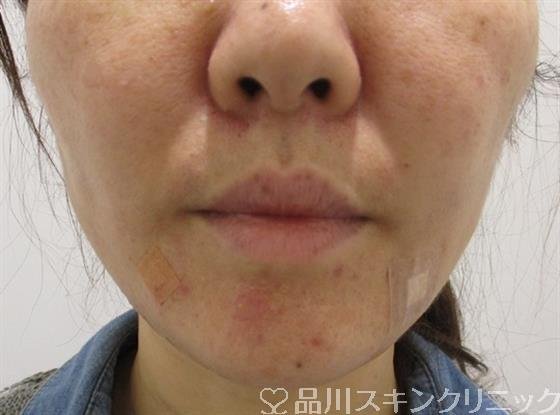 症例NO.33484のAFTER写真