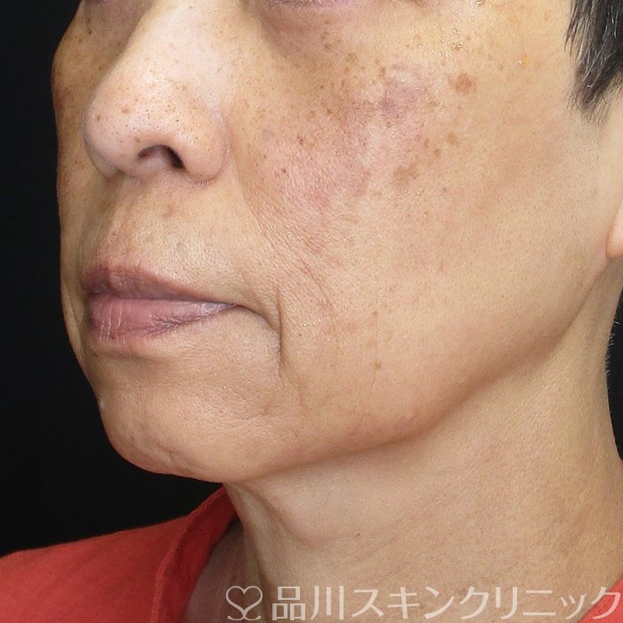 症例NO.74605のBEFORE写真
