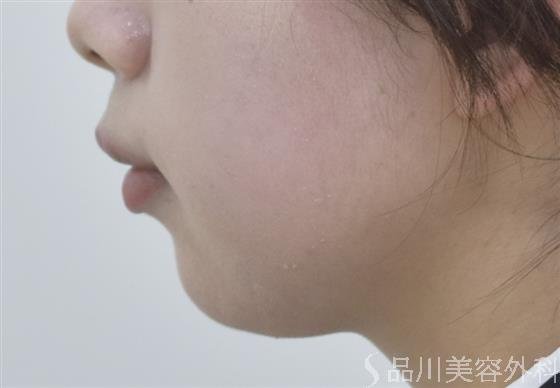 症例NO.46844のAFTER写真