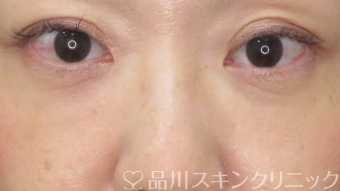 症例NO.71451のBEFORE写真