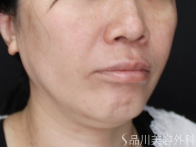 症例NO.71598のAFTER写真