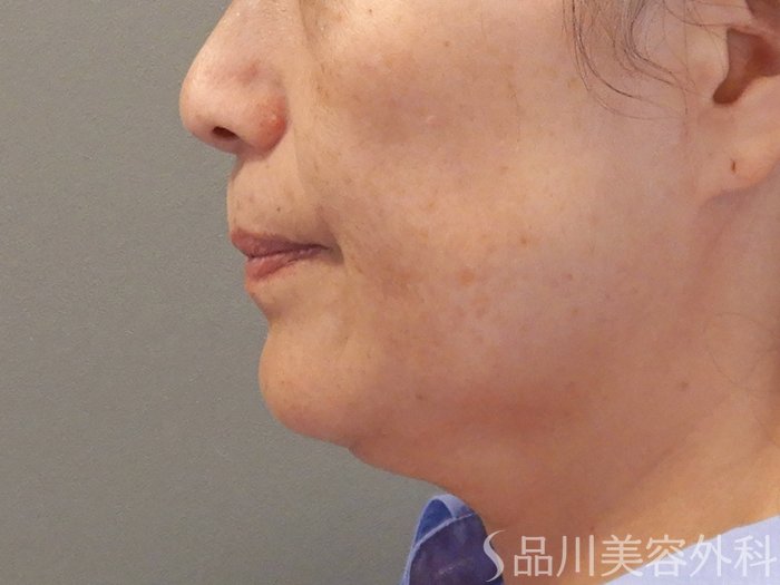 症例NO.71484のBEFORE写真
