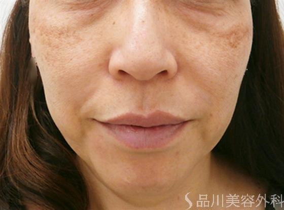 症例NO.13781のBEFORE写真