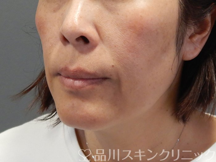 症例NO.69479のBEFORE写真