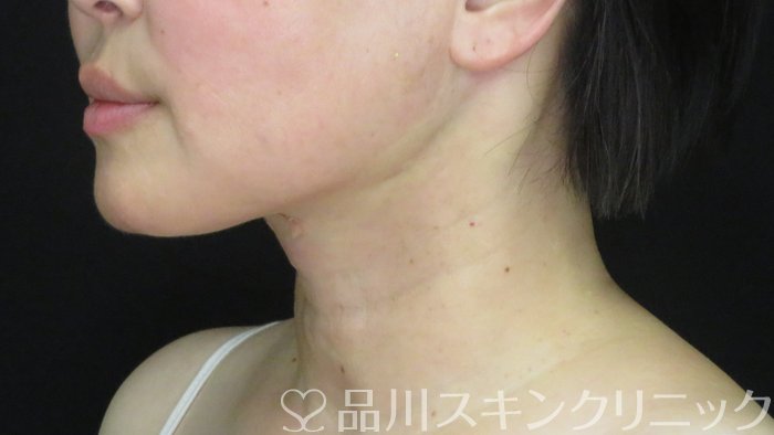 症例NO.71779のAFTER写真