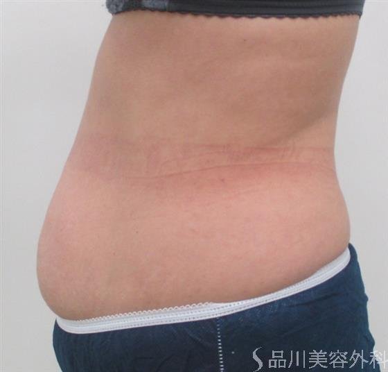 症例NO.22506のBEFORE写真