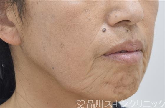 症例NO.43083のBEFORE写真