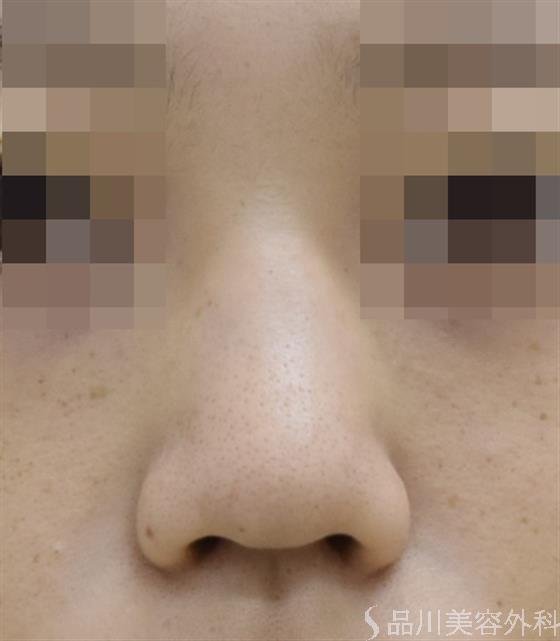 症例NO.44115のBEFORE写真