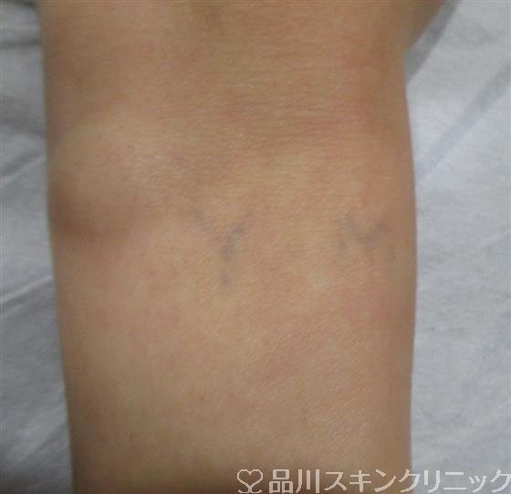 症例NO.32879のBEFORE写真