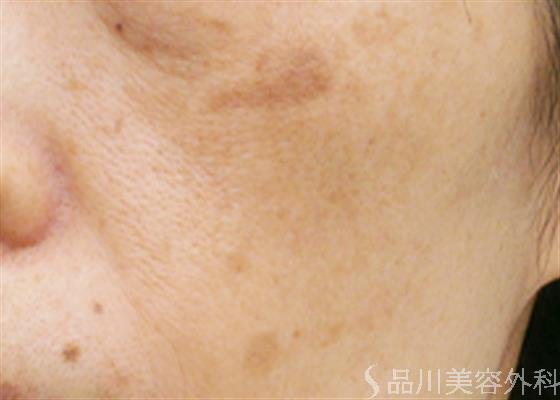症例NO.24373のAFTER写真