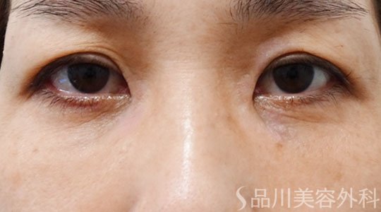 症例NO.74347のAFTER写真