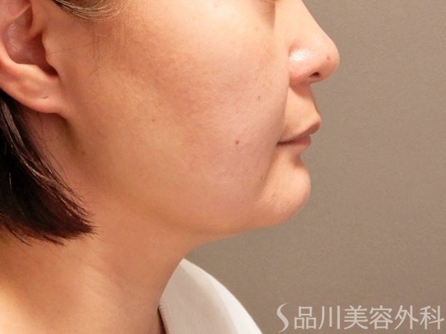 症例NO.70314のBEFORE写真