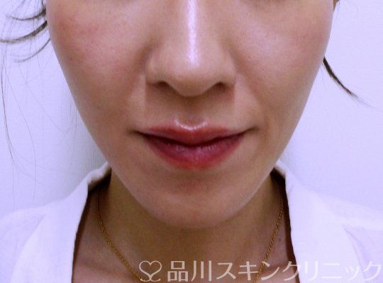 症例NO.65058のBEFORE写真