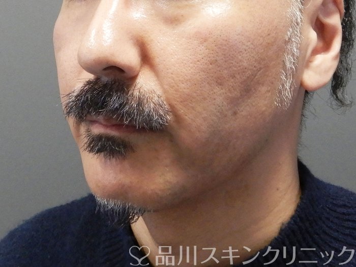 症例NO.72411のBEFORE写真