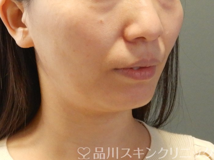 症例NO.63836のBEFORE写真