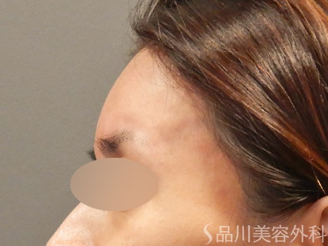 症例NO.71727のAFTER写真