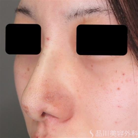 症例NO.50190のAFTER写真