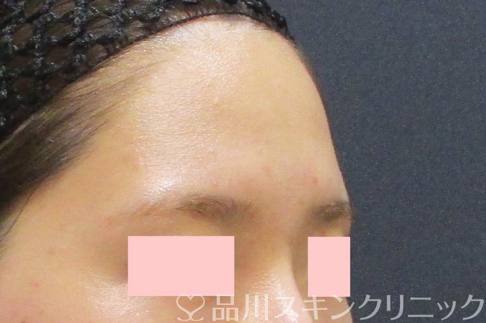 症例NO.69554のBEFORE写真