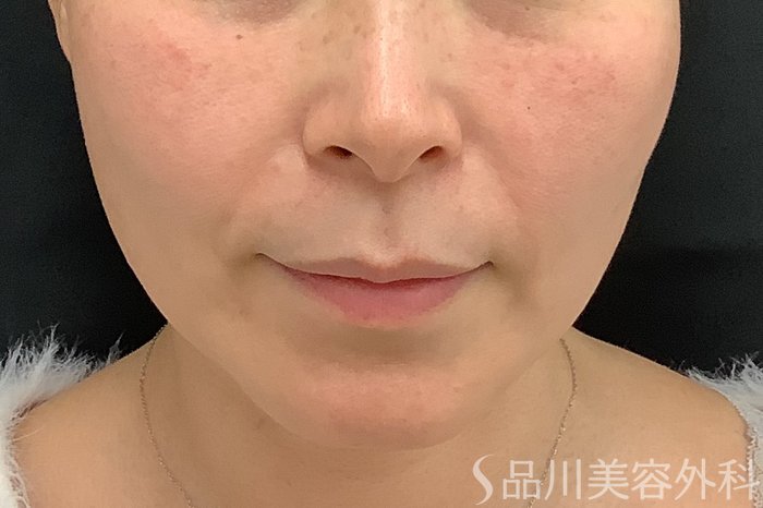 症例NO.73322のBEFORE写真