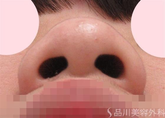 症例NO.29531のBEFORE写真