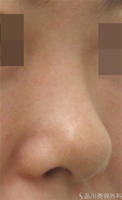 症例NO.20341のBEFORE写真