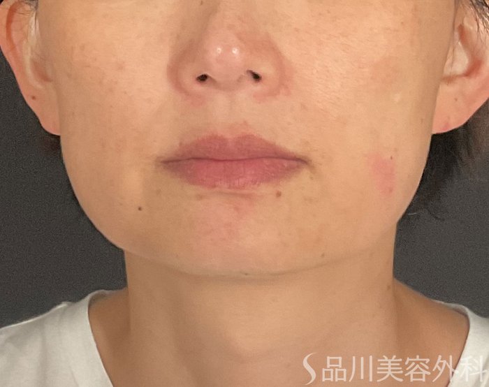 症例NO.75052のBEFORE写真