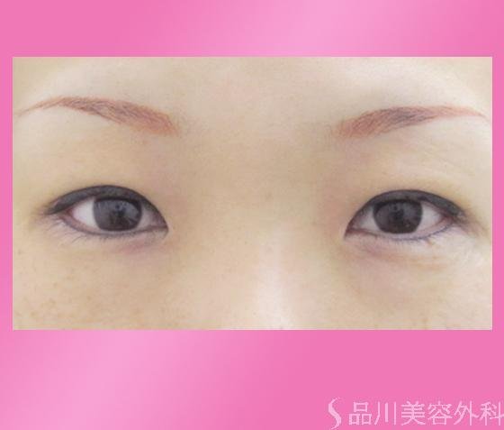 症例NO.918のAFTER写真