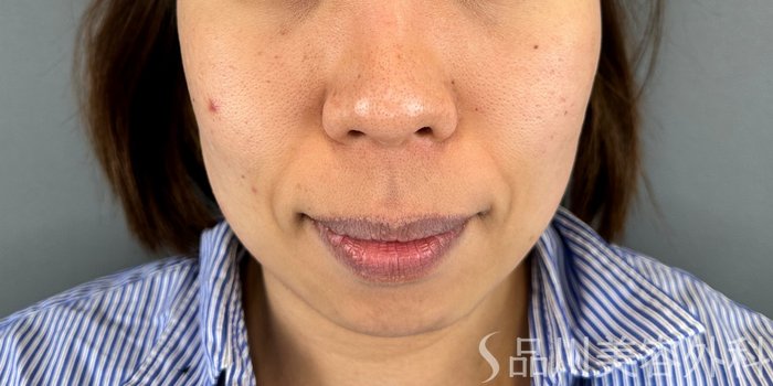 症例NO.64927のBEFORE写真