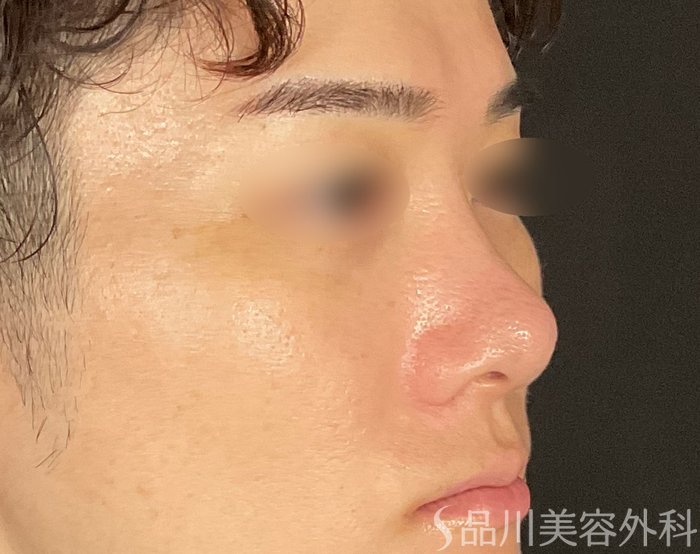 症例NO.75114のAFTER写真
