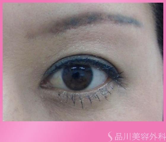 症例NO.1154のAFTER写真