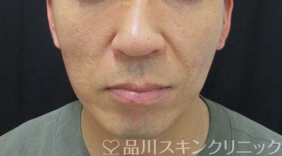 症例NO.70654のBEFORE写真