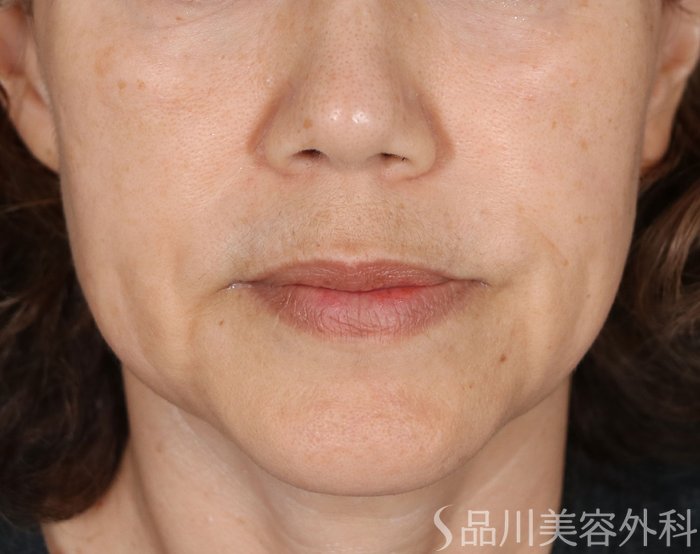 症例NO.74050のBEFORE写真