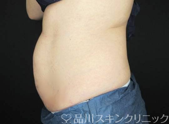 症例NO.74932のBEFORE写真
