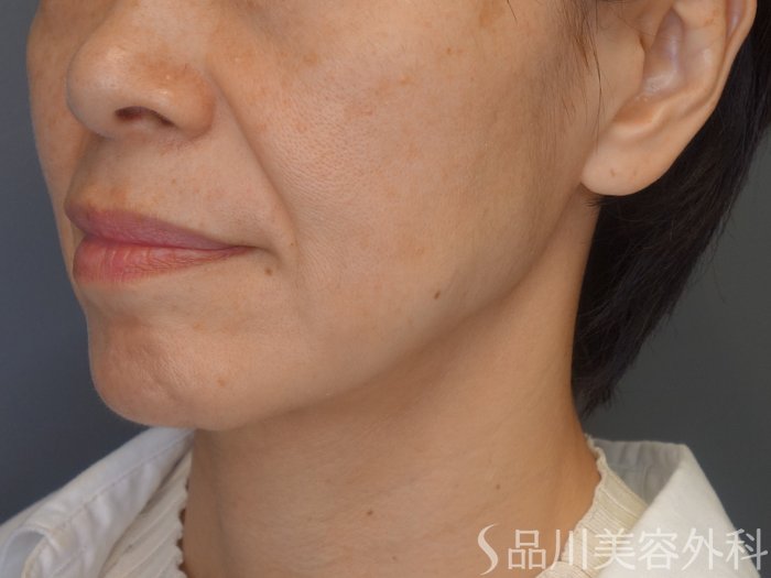 症例NO.65495のBEFORE写真