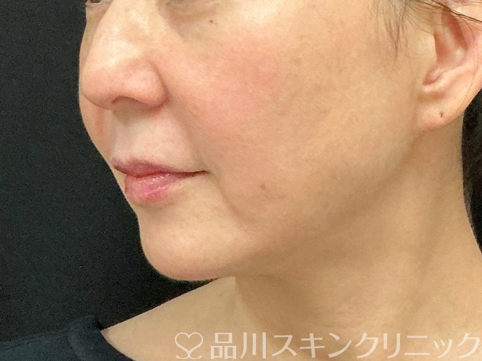 症例NO.74331のBEFORE写真