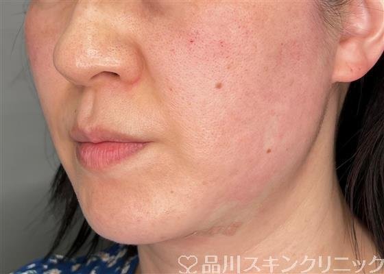 症例NO.59132のAFTER写真