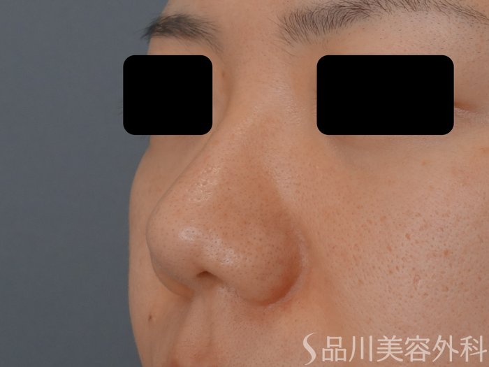 症例NO.72263のBEFORE写真