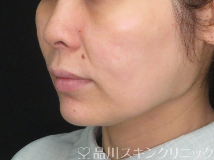 症例NO.74784のBEFORE写真