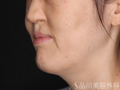 症例NO.72633のBEFORE写真