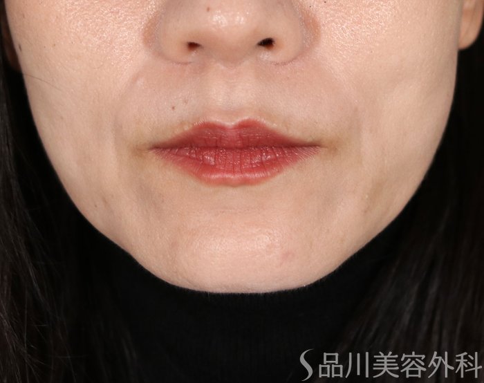 症例NO.72186のAFTER写真