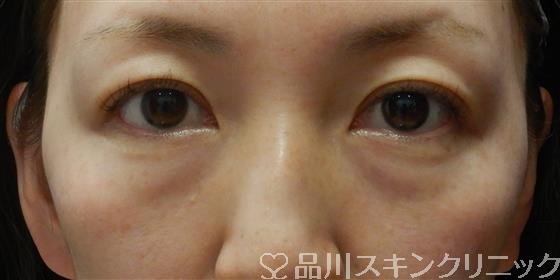 症例NO.61174のBEFORE写真