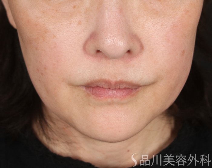 症例NO.73923のBEFORE写真