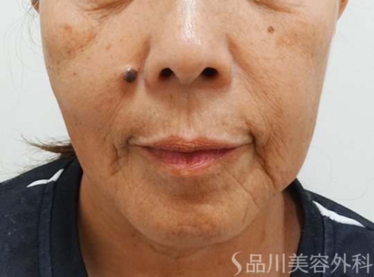 症例NO.73210のBEFORE写真