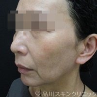 症例NO.71572のBEFORE写真