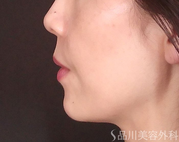 症例NO.71393のAFTER写真