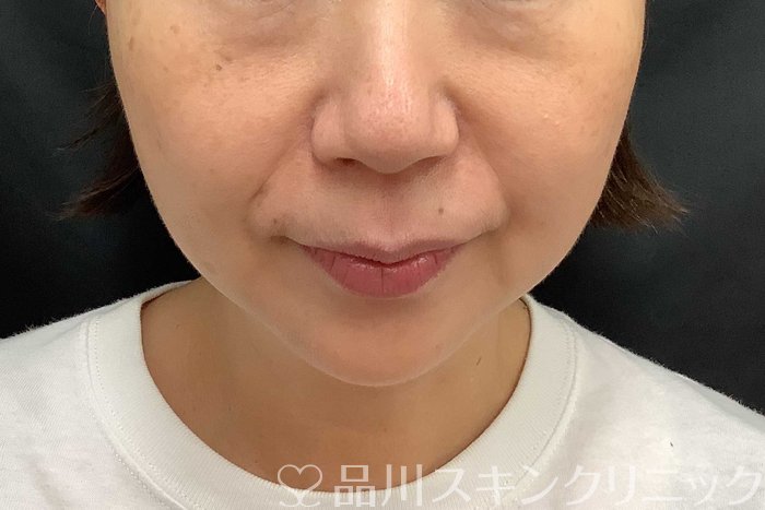 症例NO.69779のAFTER写真