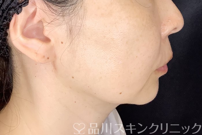 症例NO.70751のAFTER写真