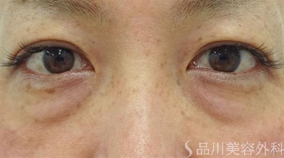 症例NO.43022のBEFORE写真